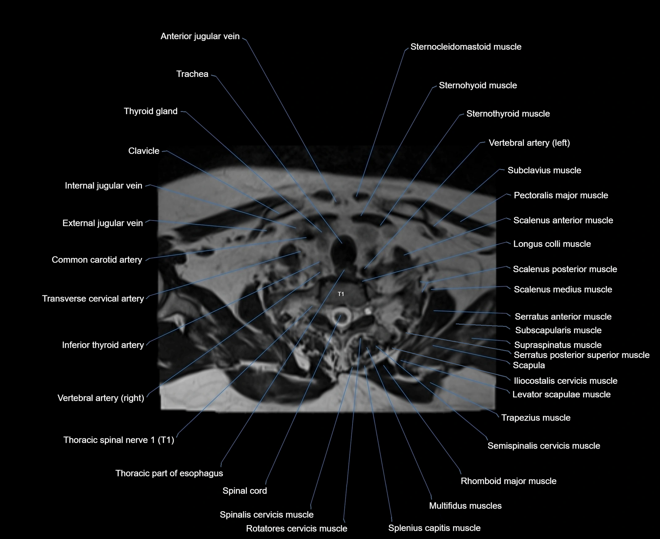 MRI Neck 3D labelled cross section anatomy axial 3t image-00001-00084.webp
